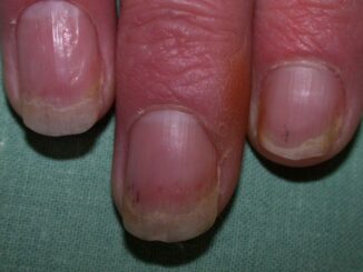 11 Effective natural home remedies to cure nail psoriasis