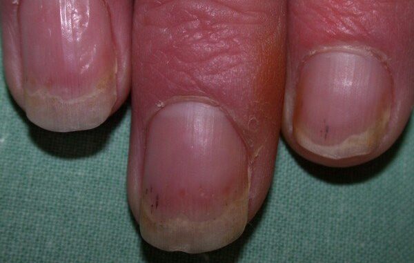 11 Effective natural home remedies to cure nail psoriasis 11 Effective natural home remedies to cure nail psoriasis