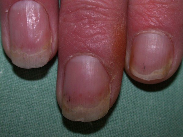11 Effective natural home remedies to cure nail psoriasis