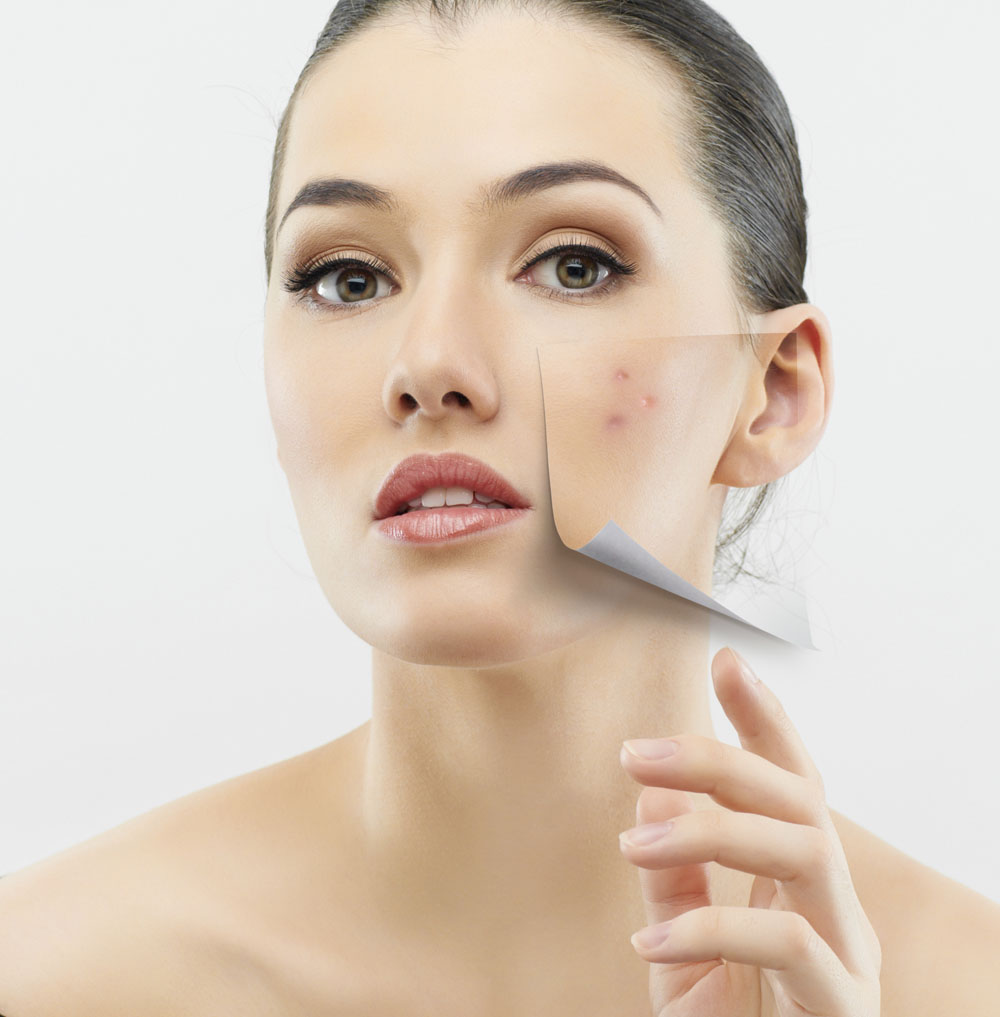 How Easily To Get Rid Of Acne Scars Naturally