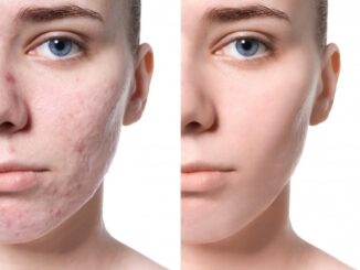 How easily to get rid of acne scars naturally