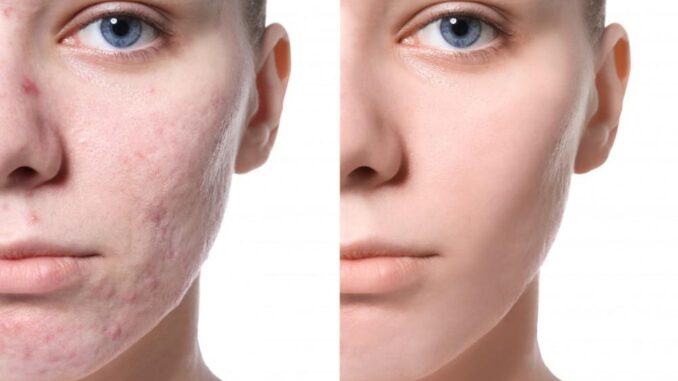 How easily to get rid of acne scars naturally How easily to get rid of acne scars naturally