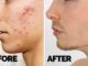 How to get rid of acne fast & naturally