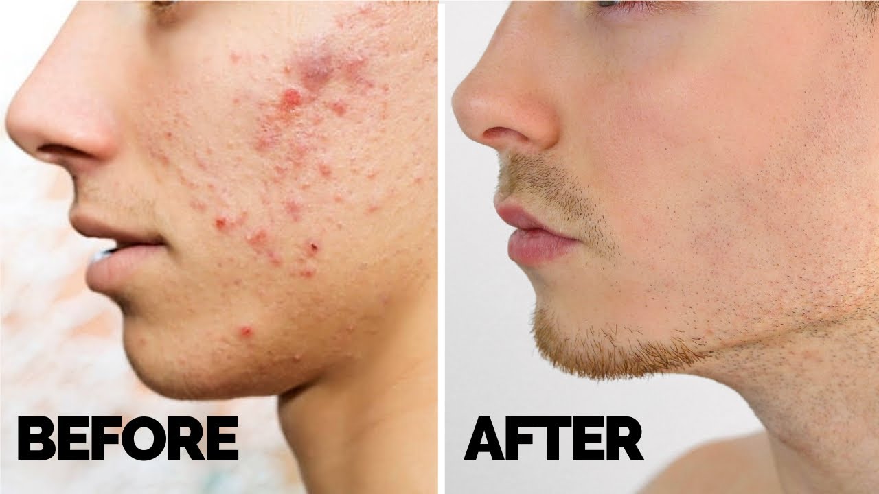 How to get rid of Acne is one of the most search term on google