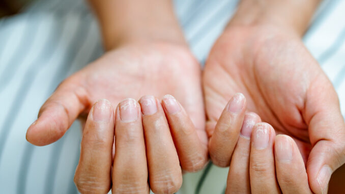 Prevention is best nail psoriasis treatment