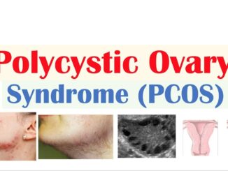 Polycystic Ovary Syndrome (PCOS): Symptoms, Cause, and Treatment