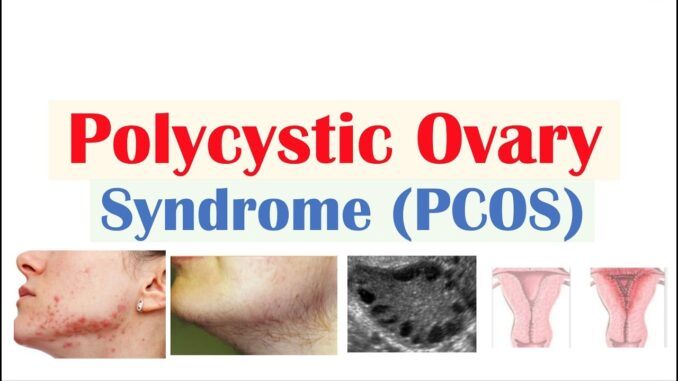 Polycystic Ovary Syndrome (PCOS): Symptoms, Cause, and Treatment