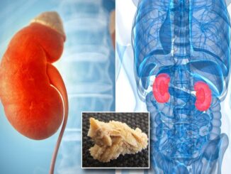 What cause kidney stones and how to get rid of it