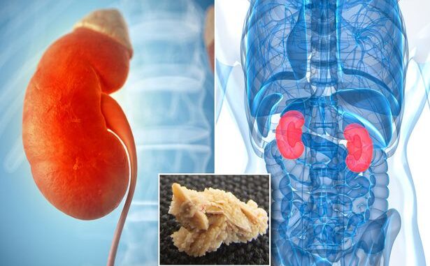 What cause kidney stones and how to get rid of it