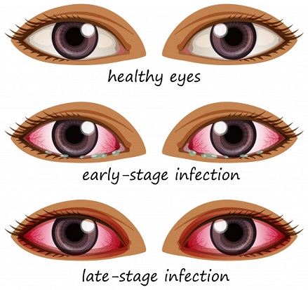 Conjunctivitis-common-eye-disease