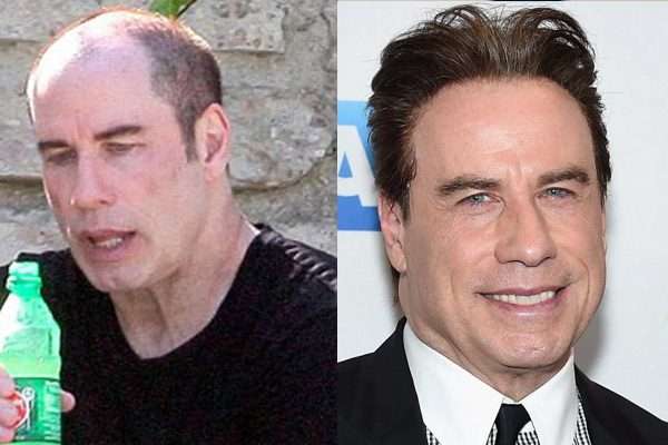 John-Travolta-plastic-surgery