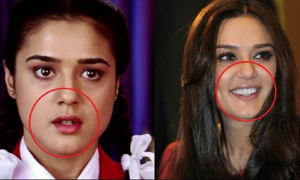 Preity-Zinta-Plastic-Surgery-before-after