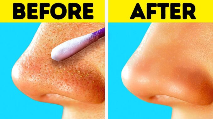 Get Rid Of The Blackheads