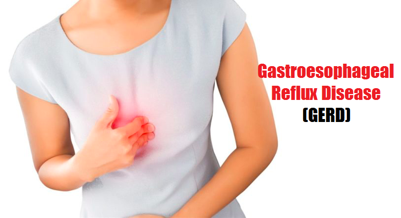 Gastroesophageal Reflux Disease