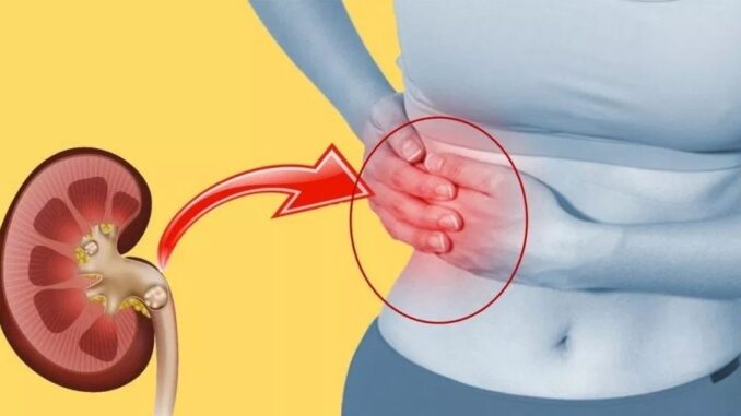 Remove Kidney Stones Without Surgery