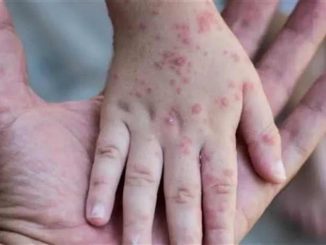 Does Covid increase the risk of Monkeypox's spread