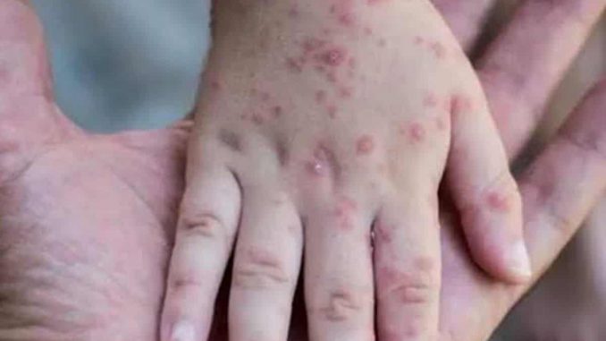 Does Covid increase the risk of Monkeypox's spread