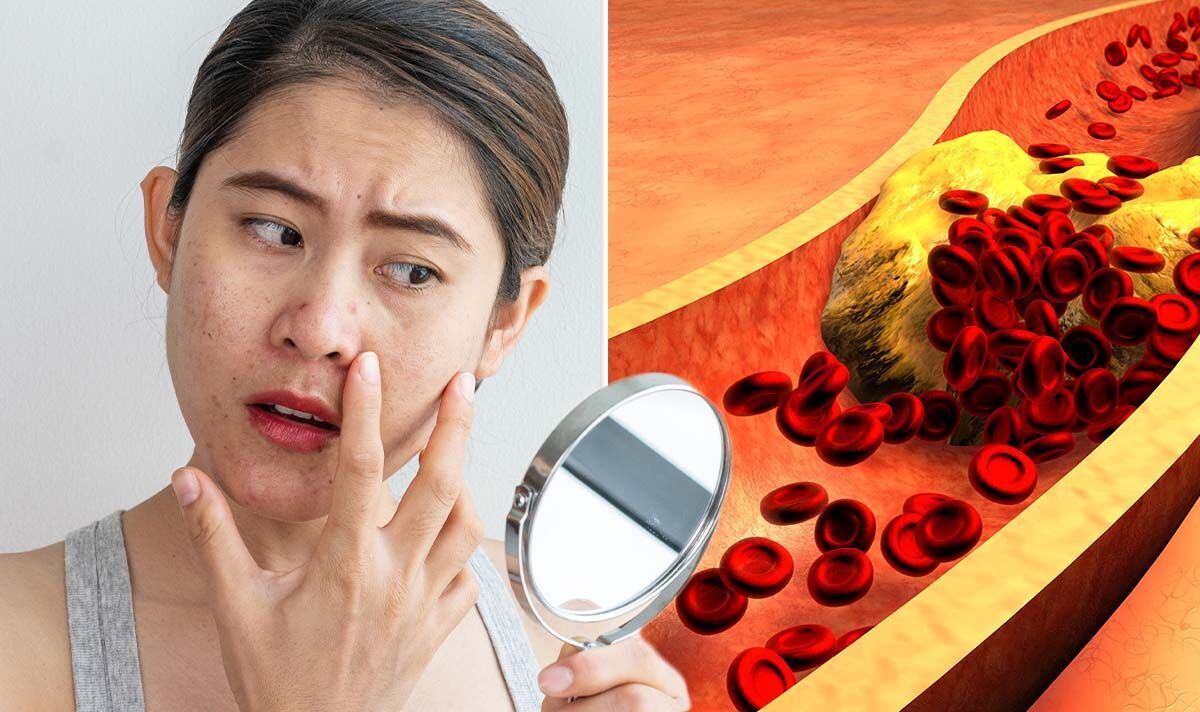 High Cholesterol Can Be Detected On The Face.