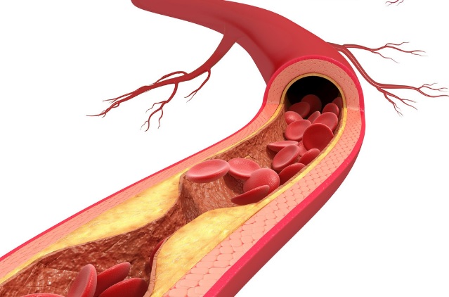 High Cholesterol Symptoms