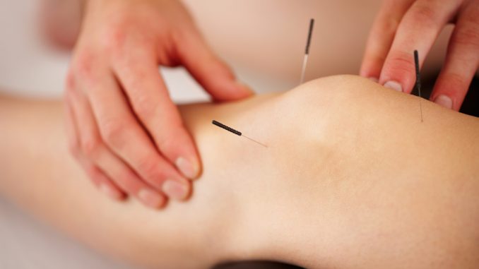 acupuncture therapy