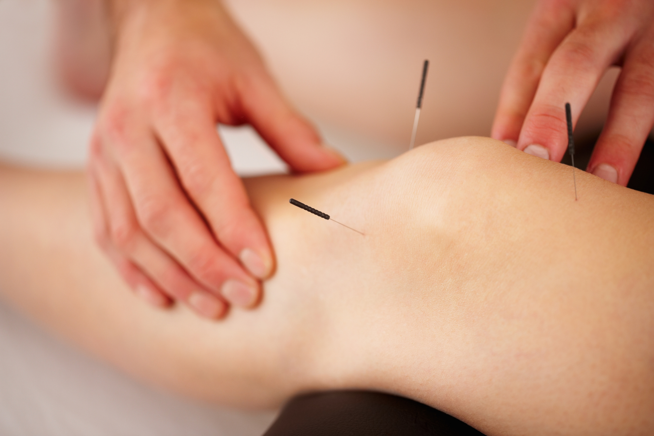 acupuncture therapy