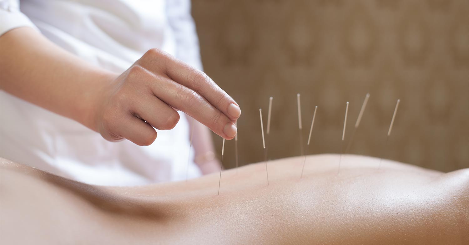 Acupuncture Treatment