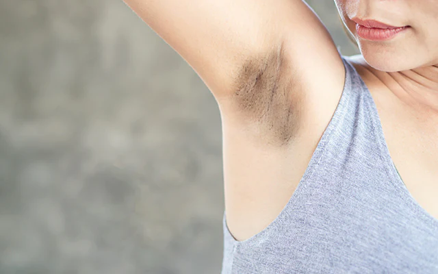 Remedies to Brighten up Your Dark Underarms