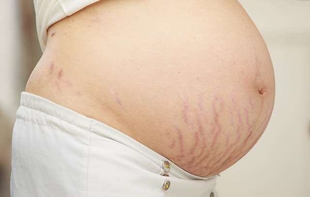 Stretch Marks in pregnent women