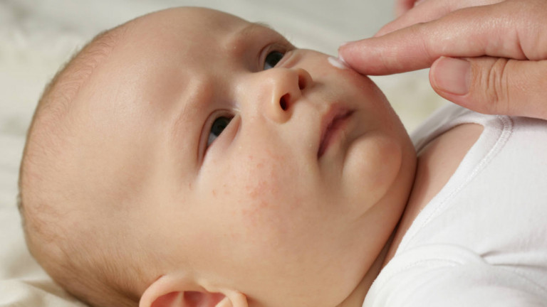 Advice for parents dealing with a baby who has a rash