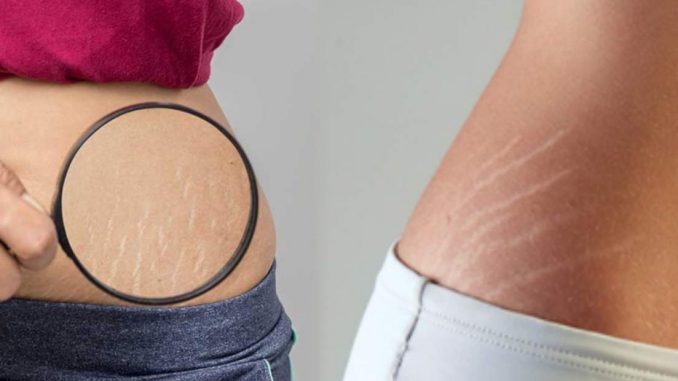 Stretch Marks Removing techniques