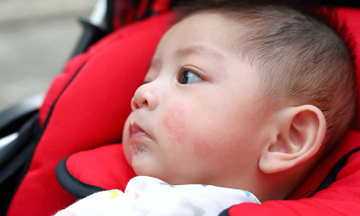 rashes in Infants