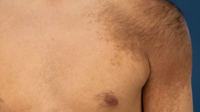 Becker's Nevus Treatment