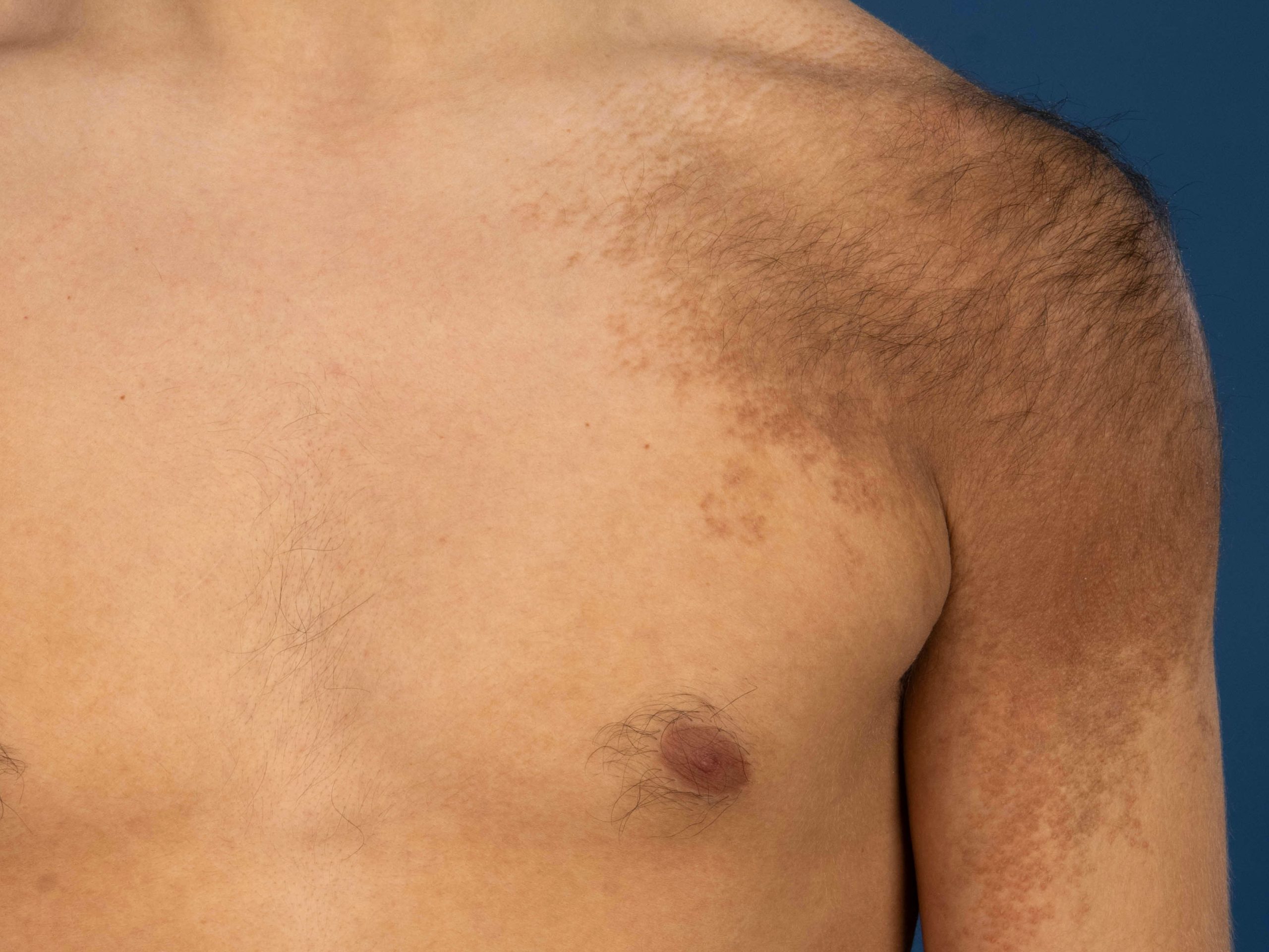 Becker's Nevus Treatment Advantages of Laser Therapy over Plastic